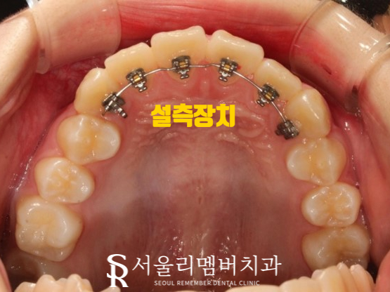 인비절라인을 사용한 치아 총생 개선 증례! 청룡동 치과 관련 이미지 4