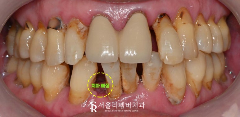 서울대입구역 치과 잇몸이 내려앉아서 고민이라면 전악 임플란트로 해결 관련 이미지 1