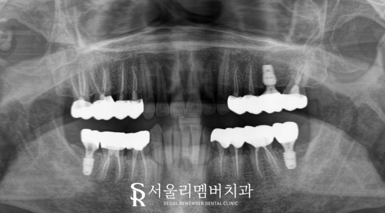 서울대입구역 치과 어금니 상실로 무너진 수직 고경과 과개 교합, 신경치료 크라운과 임플란트로 개선할 수 있다면 관련 이미지 9