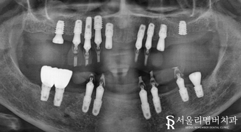 빠져버린 치아 그대로 내버려 두면 안모변형을 초래할 수 있습니다! 신림역 서울 리멤버 치과 관련 이미지 5
