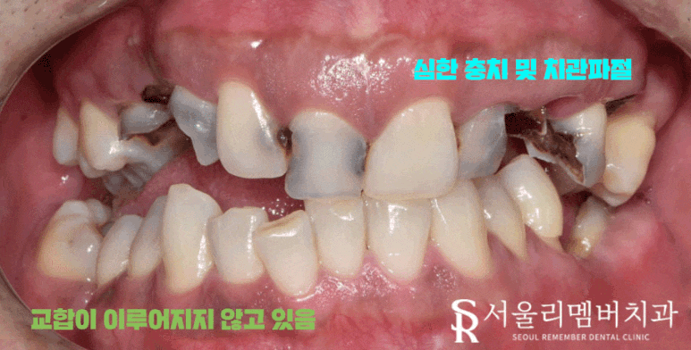 임플란트와 치아교정, 동시에 치료받을 수 있을까요? 남성역 서울 리멤버 치과 관련 이미지 1