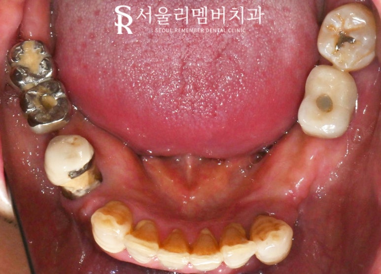 서울대입구역 치과 "부분틀니에서 임플란트로" 바꿔서 전악 개선해 드린 증례 관련 이미지 2