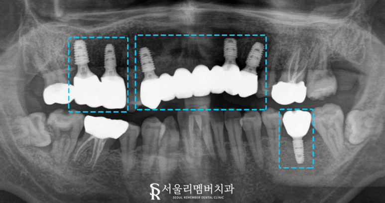 때늦은 치료, 임플란트와 크라운으로 바로잡는 서울대입구역 치과 관련 이미지 5