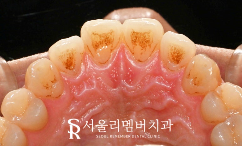 15분이면 신림 치과 스케일링 착색 제거로 까맣고 누런 치석 없앨 수 있습니다. 관련 이미지 2