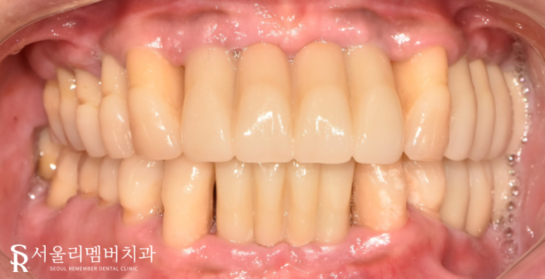 치석이 발치로 이어질 수 있다는 말, 사실일까요?! 봉천동 서울 리멤버 치과 관련 이미지 7