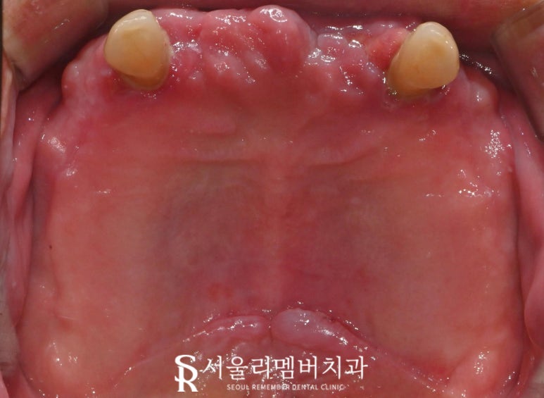 치아가 없을 땐? 서울대입구역 치과 에서 부기 통증 없는 최소절개 전체 디지털 임플란트 치료 관련 이미지 4