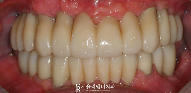 신대방 치과 고난도 전악 임플란트 수술 가능 관련 이미지 8