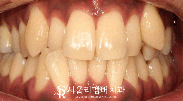 서울대입구역 치과 에서 들쑥날쑥 했던 치열, 비발치로 개선해 드렸습니다. 관련 이미지 10