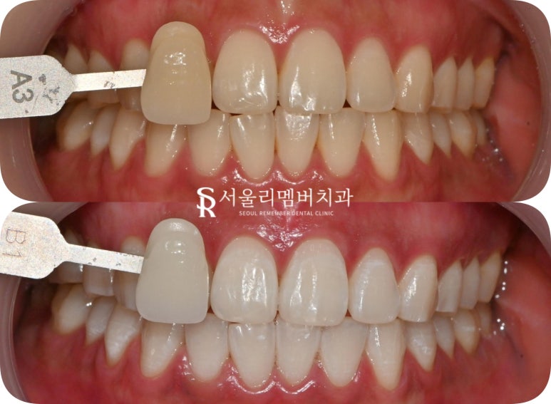 봉천동 치과 의사가 알려주는 치아미백 방법, 효능, 원리, 주의 사항 관련 이미지 5