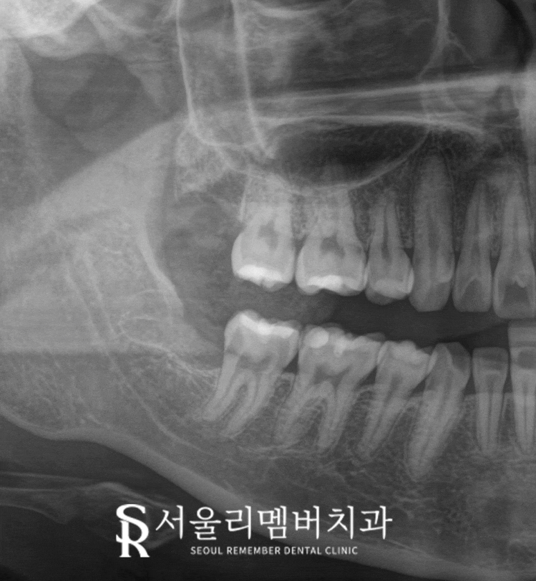 사랑니 주변 잇몸이 자꾸 붓고 아프다면? 서울대입구역 치과 발치 꼭 해야 될까? 관련 이미지 3