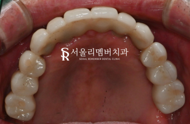 전체 보철을 할 수 밖에 없었던 이유, 서울대입구역 치과 교합 되살리기 관련 이미지 7