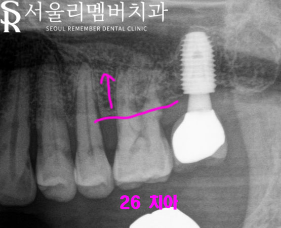 상도동 치과 다수의 충치, 임플란트와 신경치료 한 사례 (치경부 치석 관리의 중요성) 관련 이미지 3