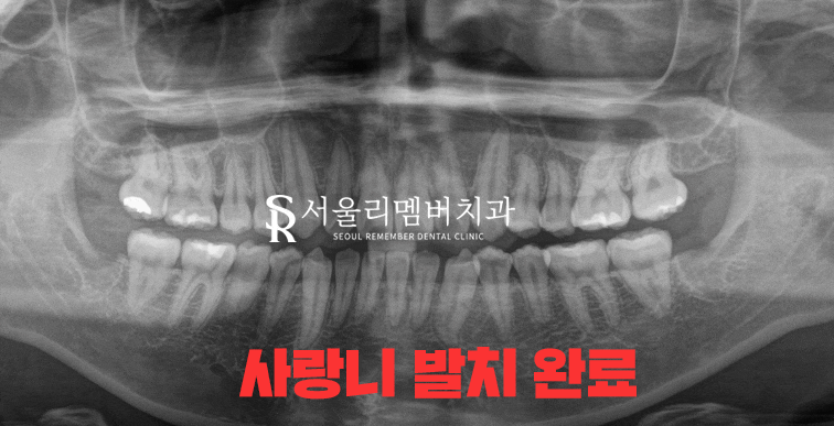 사당역 치과 사랑니 발치 시 이곳을 조심해야 됩니다! (하치조신경/상악동) 관련 이미지 3