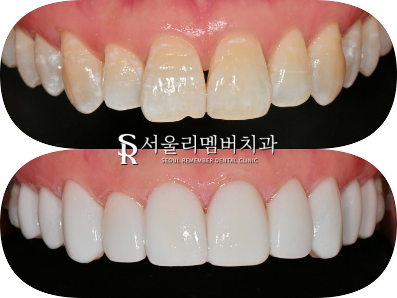 앞니 탈회 초기 충치 절단연 깨짐 치아 길이 안맞음 서울대입구 치과 전치부 리얼네이트 치료 과정 관련 이미지 7