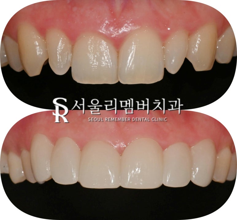 봉천동 치과 작은 앞니 왜소치 최소 삭제 및 통증 손상 없는 리얼 라미네이트 (Laminate)로 6전치 보철 수복 치료 관련 이미지 6