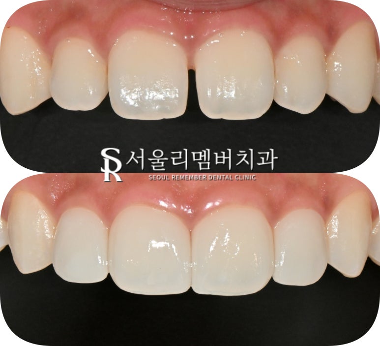 앞니 벌어짐, 레진 말고 라미네이트로 사이 틈새 자연스럽게 채우자 서울대입구 치과 상악 전치부 리얼네이트 케이스 관련 이미지 1
