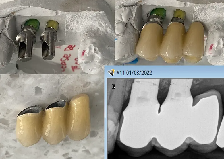 아래 앞니 임플란트 수명 얼마나 될까? 서울대입구역치과 에서 제대로 된 치료 받으세요. 관련 이미지 4