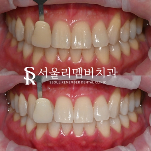 누런 이가 고민이라면? 봉천동 치과 전문가 원데이 치아미백으로 해결 관련 이미지 3