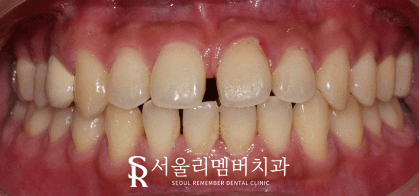 벌어진 치아, 사당 치과 인비절라인으로 개선할 수 있을까? 관련 이미지 2