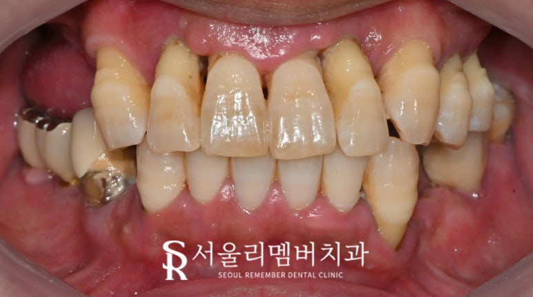 서울대입구역 치과 "부분틀니에서 임플란트로" 바꿔서 전악 개선해 드린 증례 관련 이미지 3
