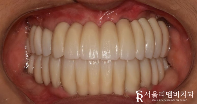 금방이라도 빠져버릴 것 같은 치아들, 전체임플란트 식립으로 개선했던 이야기. 이수역 서울 리멤버 치과 관련 이미지 8