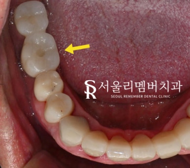 야간 진료 가능한 서울대입구역 치과 에서 퇴근 후에도 임플란트 하실 수 있습니다. 관련 이미지 6