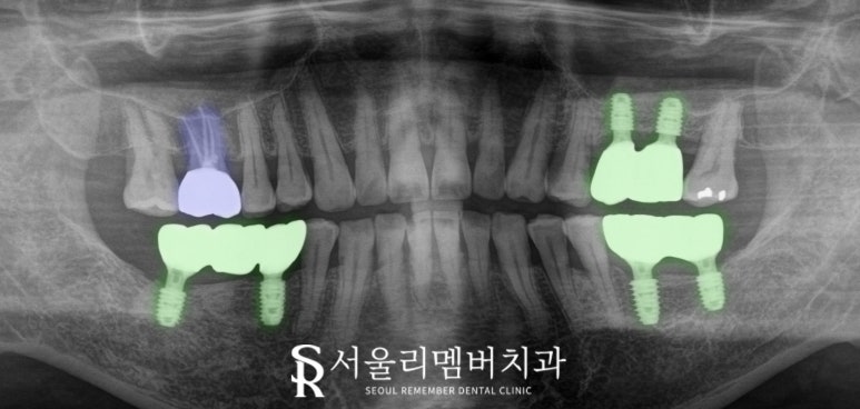 해외 거주하는 한국인, 임플란트 치료는 국내에서 받고 싶다면? 상도동 치과 수술 계획 및 과정 관련 이미지 6
