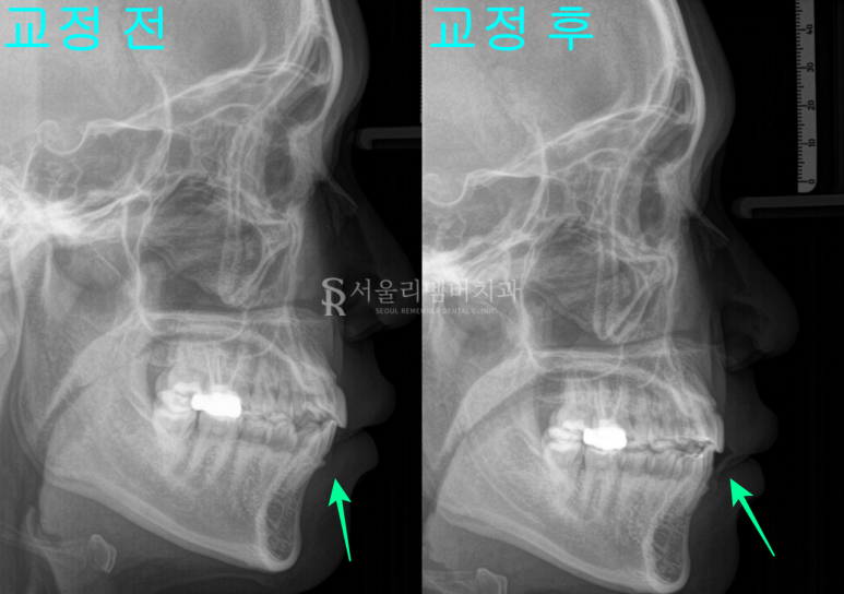 A “Pop-Out” Tooth, Cavities in the Front Teeth and Molars: Orthodontic and Cavity Treatment at a Sindae-bang Dental Clinic image 4