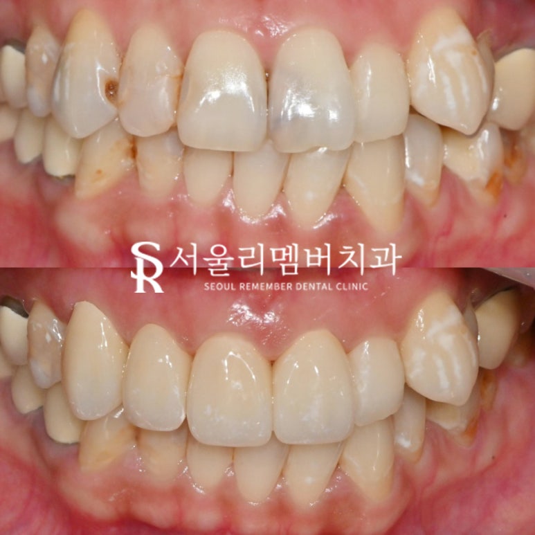 앞니 레진 탈락과 검게 변한 치아, 신림 치과 충치치료 후 크라운으로 개선 관련 이미지 2