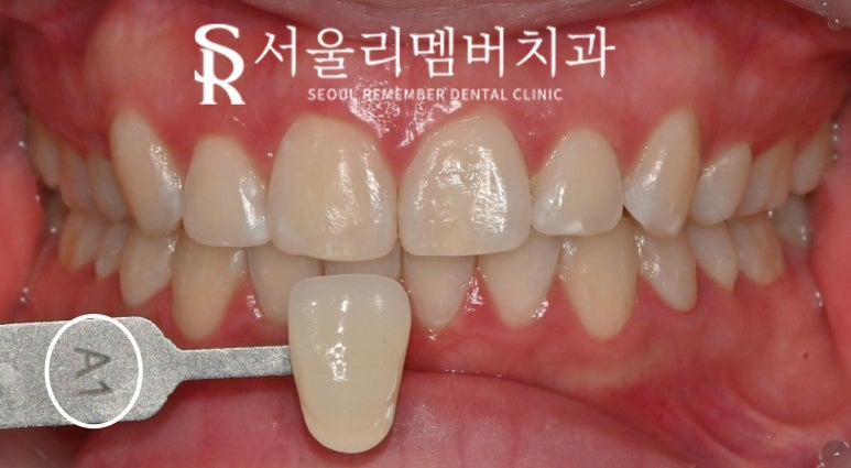 신림 치과 원데이 치아미백 (feat. 쿠*, 올*브영 아닌 식약처 등록된 안전한 전문가용 약제 사용) 관련 이미지 3