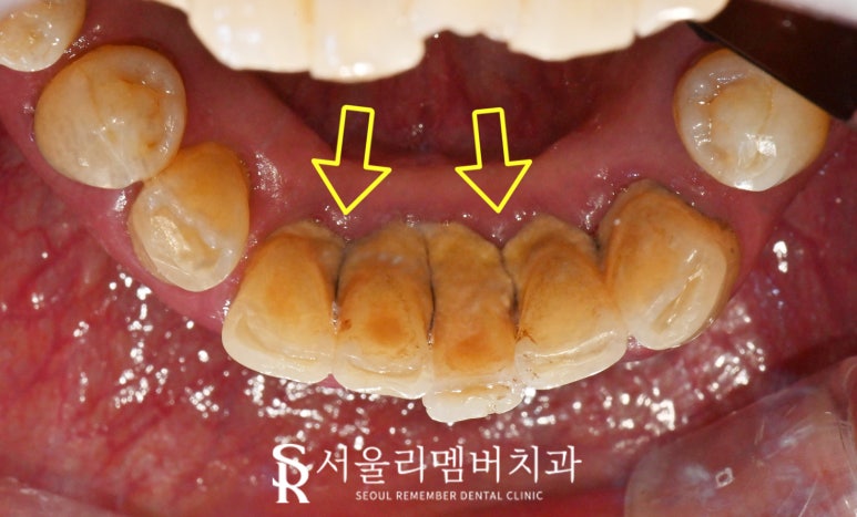 사당 치과 하악 전치 신경치료 브릿지로 살리고 나머지 임플란트로 재건한 전악 증례 관련 이미지 5