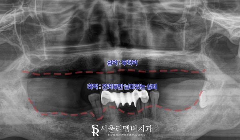 과잉진료 없는 보라매 치과 에서 최소 개수 전악 임플란트 식립 관련 이미지 3