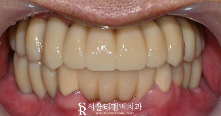 과잉진료 없는 보라매 치과 에서 최소 개수 전악 임플란트 식립 관련 이미지 6