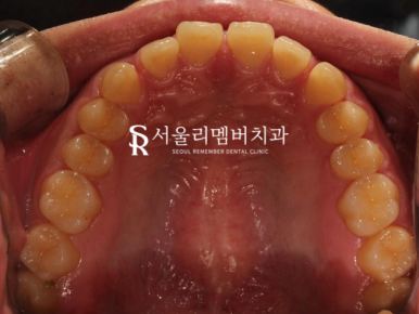상도동치과 에서 발치 없이 깊게 물리는 과개교합 및 2급 부정교합 개선! 관련 이미지 5