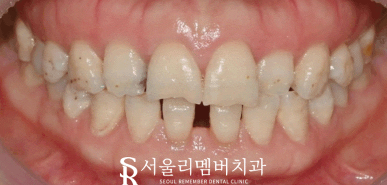 "앞니 벌어짐 어떻게 해결할까?" 신림역 치과 의 치료방법 관련 이미지 1