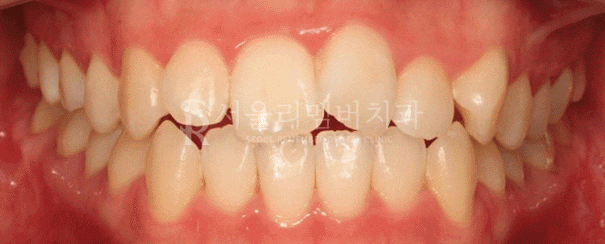 서울대입구역 치과 툭 튀어나온 돌출 때문에 발치교정 진행 관련 이미지 11