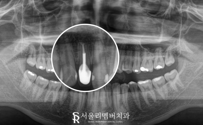 앞니 뿌리 끝 염증, 치근단 절제술(apicoectomy) 보라매 치과 관련 이미지 8