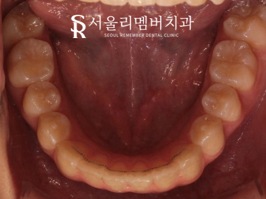 인비절라인을 사용한 치아 총생 개선 증례! 청룡동 치과 관련 이미지 15