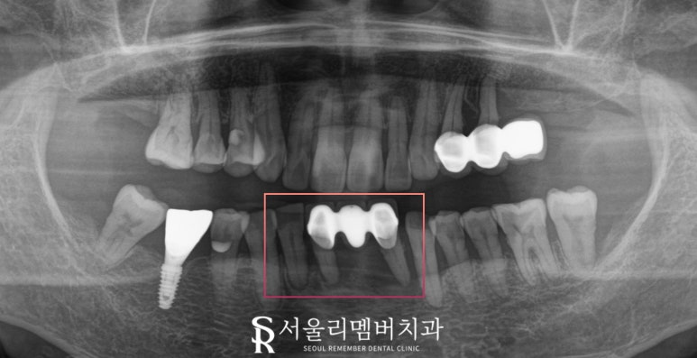 Loose Lower Front Teeth, Sillim Station Dental Clinic, Insurance Anssurge Implant for Patients 65 and Older, Minimal Placement, Lower Cost, Faster Completion image 4