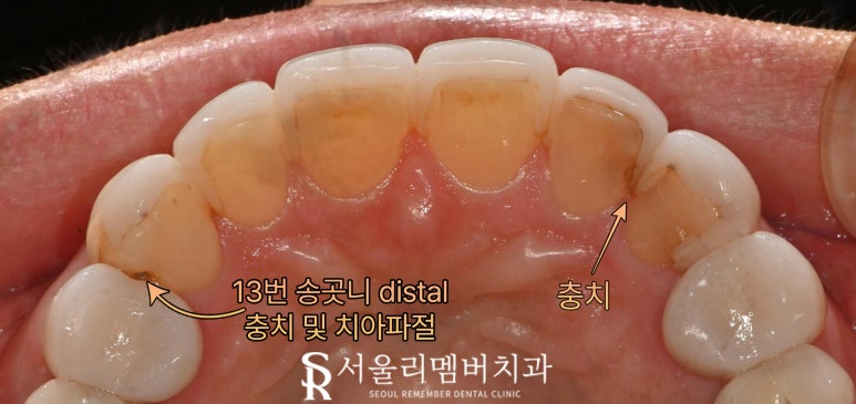 기존 라미네이트 보철 변색 및 송곳니 파절 안쪽으로 이차 우식 생겼을 때 신림역 치과 수면으로 충치치료 리얼네이트 당일 진료 가능할까 관련 이미지 4