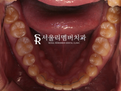 과개교합, 외적인 문제는 물론이며 기능 회복까지 개선하는 것이 중요합니다. 신대방치과 치아교정 관련 이미지 9
