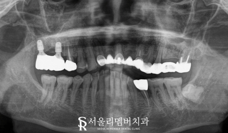 서울대입구역 치과 임플란트, 신경치료 크라운, 인레이 모두 해야 된다면 어떤 진료부터 시작해야 될까요? 관련 이미지 5