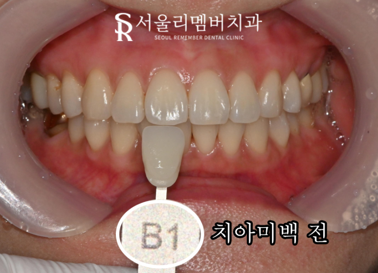 서울대입구역 치과 연말 모임 행사 준비의 시작은 원데이 치아미백 관련 이미지 2