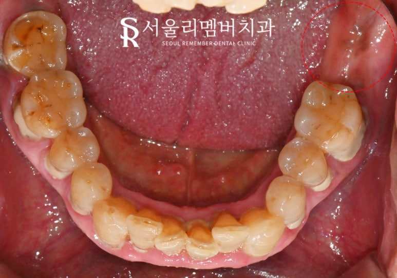 잃어버린 치아, 봉천동 치과 임플란트로 되찾는 자연스러운 미소와 건강한 저작 기능 관련 이미지 2