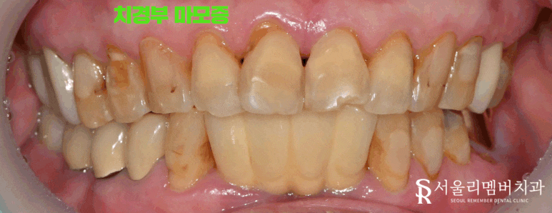 잇몸이 패여서 이가 시려요 서울대입구역 치과 레진 수복 증례 관련 이미지 1