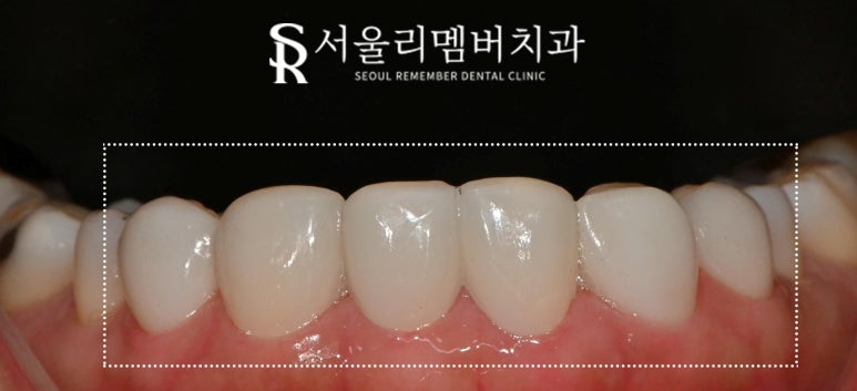 낙성대 치과 앞니 틀어짐 하악 전치 측절치 결손 라미네이트로 공간 닫기 성공 관련 이미지 7