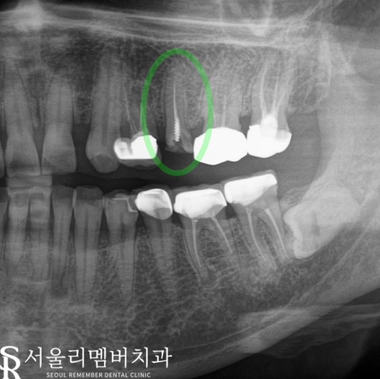 치아 곳곳에서 생긴 문제, 사당 치과 임플란트 및 크라운 치료 관련 이미지 5