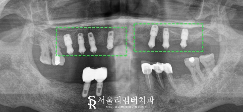 서울대입구역 치과 나에게 맞는 보철은 틀니? 임플란트? 관련 이미지 6