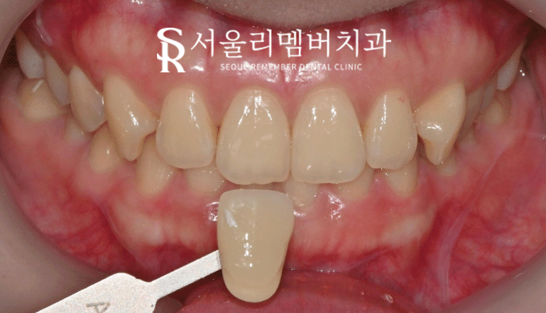 누런치아 되돌리는 뚜렷한 효과! 치아미백 잘하는 서울대입구역 치과 관련 이미지 3