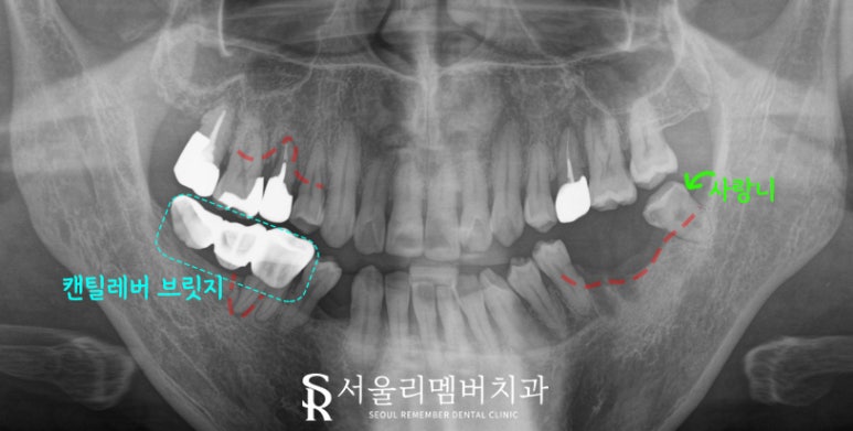 신림역 치과, 어금니 임플란트 및 보철 치료로 심미 저작 기능 개선 과정 관련 이미지 2